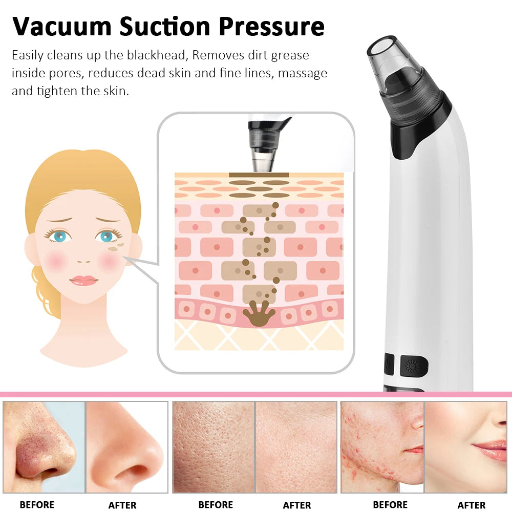 PorePerfect Electric Blackhead Remover